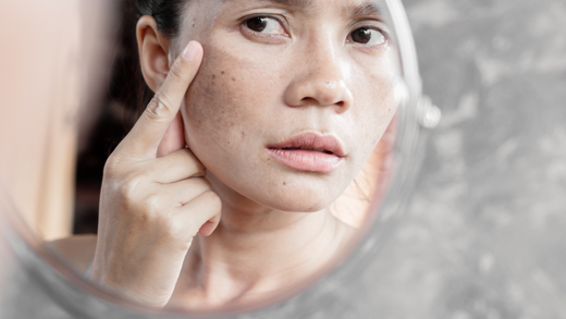 Master Skin Pigmentation with Insightful Types, Causes, and Treatments.