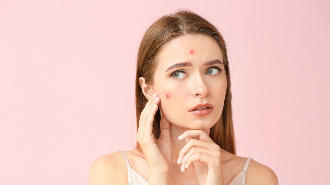 What is the Difference between Acne and Pimples?